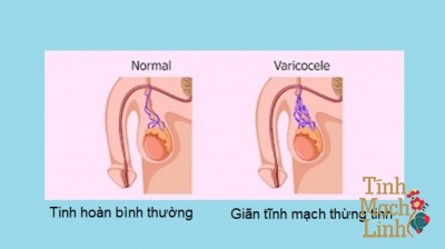 Vì sao giãn tĩnh mạch thừng tinh rất dễ bị tái phát?