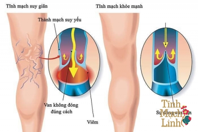 Suy van tĩnh mạch và biện pháp phòng ngừa siêu dễ dàng