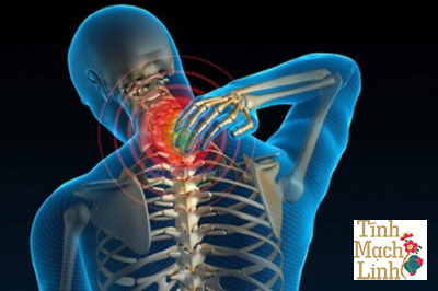 Vì sao thoái hóa đốt sống cổ gây đau mỏi vai gáy?