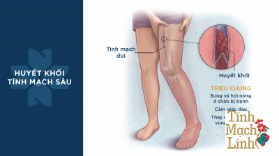Huyết khối tĩnh mạch sâu có thể gây tử vong nếu không được cấp cứu kịp thời