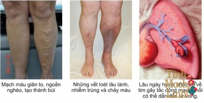 Huyết khối tĩnh mạch sâu là biến chứng nguy hiểm nhất của bệnh suy giãn tĩnh mạch