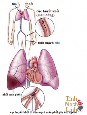 Nhận biết thuyên tắc phổi do huyết khối tĩnh mạch tránh biến chứng đột tử