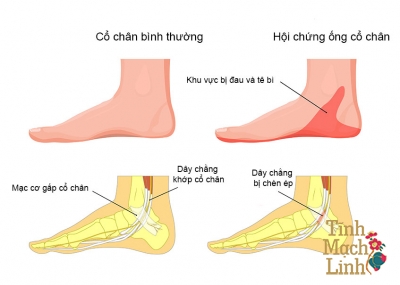 Hội chứng ống cổ chân: Những điều bạn cần biết