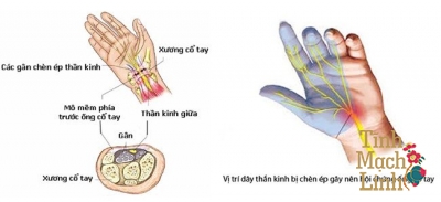 Kĩ thuật mổ Hội chứng ống cổ tay: Những điều cần lưu ý 