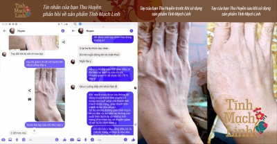 SUY GIÃN TĨNH MẠCH: KHÔNG CÒN LÀ NỖI LO