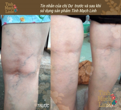 TÌM LẠI ĐÔI CHÂN KHỎE NHỜ TĨNH MẠCH LINH