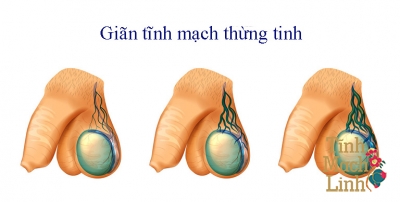 Giãn tĩnh mạch tinh hoàn độ 3 điều trị như thế nào?