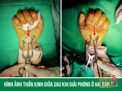 Mổ hội chứng ống cổ tay bao lâu thì lành?