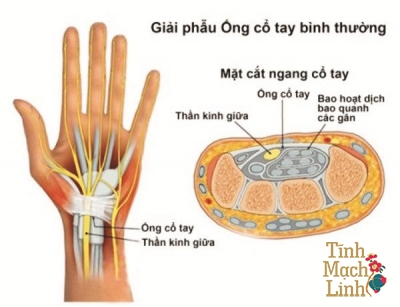 Triệu chứng ống cổ tay nhận biết sớm, điều trị nhanh
