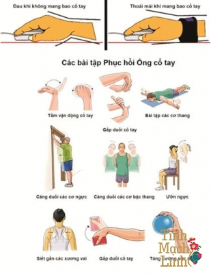 Vật lý trị liệu hội chứng ống cổ tay áp dụng sao cho đúng?