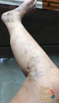 Suy giãn tĩnh mạch nông: Biện pháp điều trị theo quan điểm Y học cổ truyền