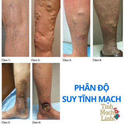 Tĩnh mạch nông là gì? Bệnh suy giãn tĩnh mạch nông có chữa được không?