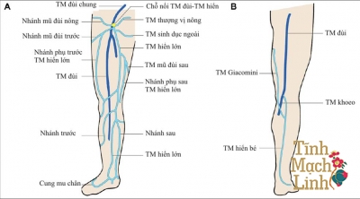 Giãn tĩnh mạch hiển lớn có dấu hiệu gì? Tổng hợp các phương pháp điều trị