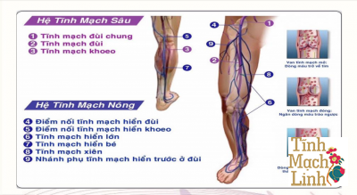 Tĩnh mạch nông của chi dưới có cấu tạo như thế nào? Top 3 bệnh lý thường gặp ở tĩnh mạch nông