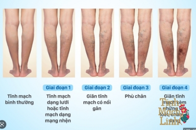 Suy giãn tĩnh mạch nông chi dưới có thuốc điều trị không?