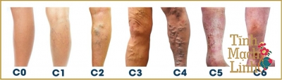 Suy van tĩnh mạch sâu: Nguyên nhân, biểu hiện, cách điều trị theo Y học cổ truyền