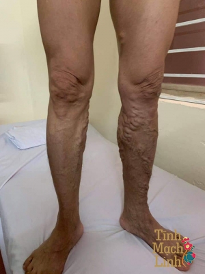 Suy van tĩnh mạch sâu hai chi dưới nhận biết sớm, chữa  kịp thời