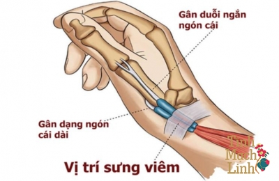 Tê ngón tay cái bên trái: Đừng nghĩ là chuyện nhỏ