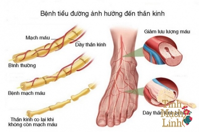 Chân bị tê, cứng cơ, đau nhức là bệnh gì?