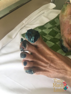 Thiếu máu chi dưới: Đừng coi thường dấu hiệu đau cách hồi 