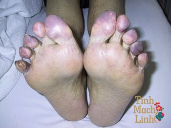Thiếu máu mạn tính chi dưới: Tỷ lệ cắt cụt chi gia tăng