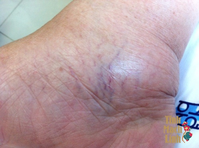 4 sự thật về bệnh suy tĩnh mạch ở chân có thể bạn chưa biết 