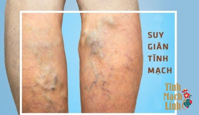 Nên điều trị suy giãn tĩnh mạch theo Đông y hay Tây y- Giải đáp của chuyên gia 