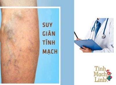 3 việc bạn nhất định cần ghi nhớ khi bị suy giãn tĩnh mạch
