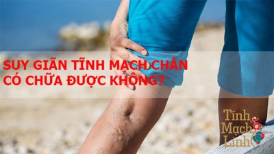 Bị giãn phần tĩnh mạch chân có chữa dứt điểm được không?