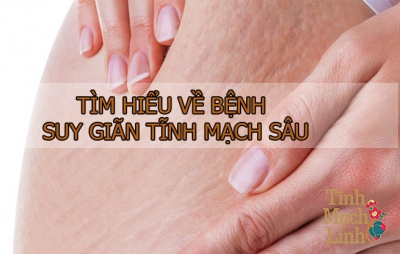 Suy giãn tĩnh mạch sâu là gì, nguy hiểm như thế nào tới sức khoẻ và đôi chân của người bệnh