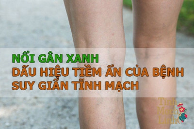 Các triệu chứng điển hình của suy giãn tĩnh mạch như dấu hiệu nổi gân xanh