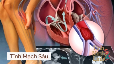 Suy giãn tĩnh mạch sâu 2 chi dưới chẩn đoán và cách điều trị Đông y