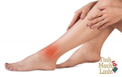 Không nên chủ quan khi thấy các tĩnh mạch chi nổi nên màu xanh hoặc tím 