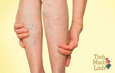 3 việc cần làm ngay khi có triệu chứng dưới da giãn, ngoằn ngoèo, đường kính các tĩnh mạch giãn to
