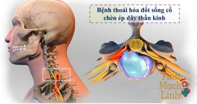 Tê bì chân tay do thoái hóa đốt sống cổ và những hệ lụy bạn không biết