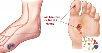 6 bệnh lý về chân 90% bệnh nhân đái tháo đường mắc phải