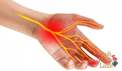 Hội chứng ống cổ tay: Nguyên nhân, dấu hiệu, cách phòng ngừa