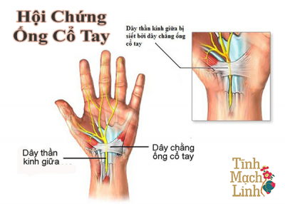 Chẩn đoán và điều trị hội chứng ống cổ tay như thế nào cho đúng?