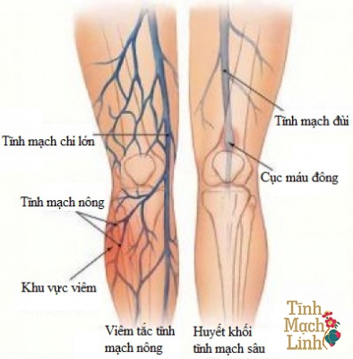 Điểm danh 11 yếu tố nguy cơ dẫn đến bệnh huyết khối tĩnh mạch sâu