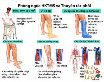 Biện pháp phòng ngừa huyết khối tĩnh mạch sâu chi dưới hiệu quả nhất?
