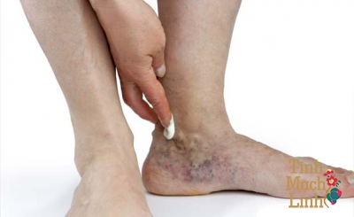 Giãn tĩnh mạch mạng nhện: Căn bệnh có thể điều trị tại nhà