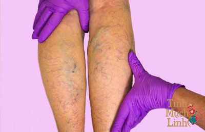 Điều trị viêm tắc tĩnh mạch chi dưới theo Đông y
