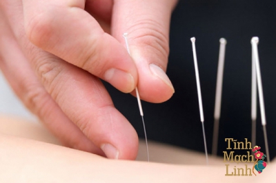 Chữa viêm tắc tĩnh mạch chi dưới bằng phương pháp châm cứu