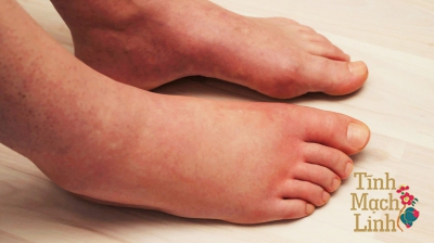 Hướng dẫn chăm sóc đôi chân cho người mắc viêm tắc tĩnh mạch chi dưới