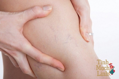 Tìm hiểu các giai đoạn của viêm tắc tĩnh mạch huyết khối sâu