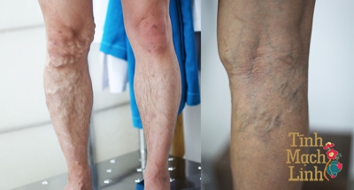 Những điều bạn cần biết về suy van tĩnh mạch sâu