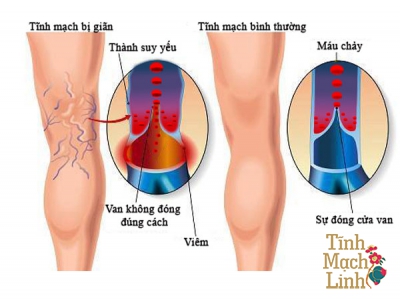 Suy giãn tĩnh mạch sâu có nguy hiểm không?