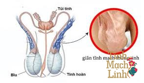 Giải đáp thắc mắc: Có nên mổ giãn tĩnh mạch thừng tinh?