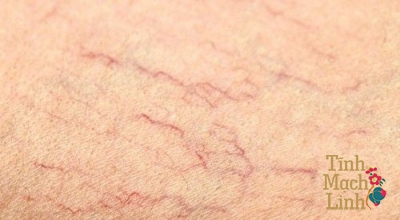Giãn tĩnh mạch mạng nhện có cần điều trị không?