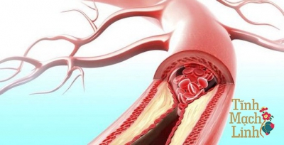 Ngăn ngừa biến chứng của tắc động mạch chi dưới gây đoạn chi